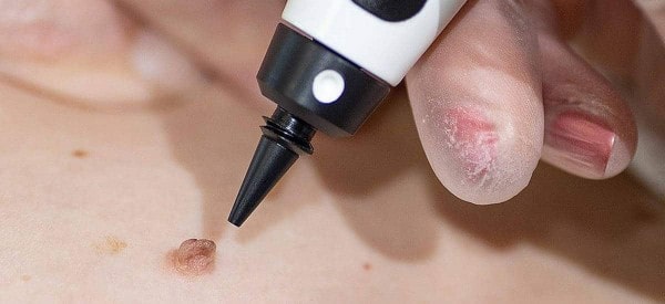 After Skin Tag Removal Woodford