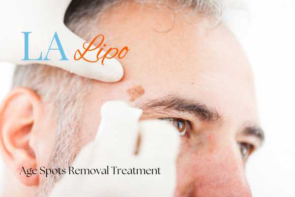 What Are the Most Effective Treatments for Age Spots Woodford?