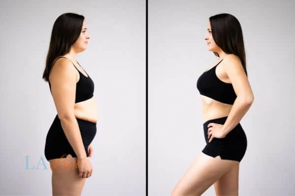 image of woman before and after results of LA-EMS Body Sculpting Woodford to help treat Diastasis recti