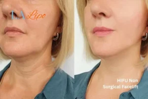 hi-fu for wrinkles Woodford before and after results