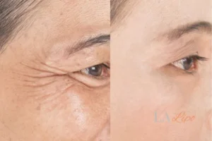 Before and after results of woman - HI-fu wrinkles reduction treatment Woodford