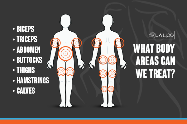 Graphic to show areas you can have LA-EMS Body Sculpting Woodford treatment.
