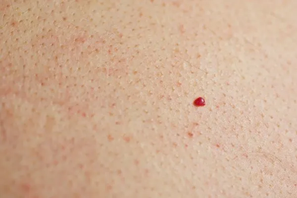 close up of a cherry angioma Woodford