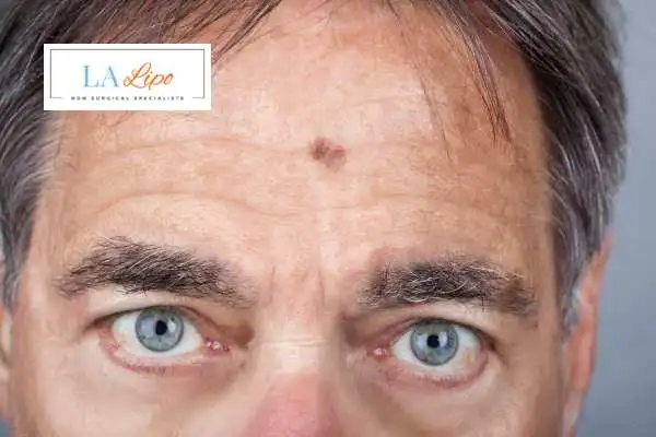 Solar Lentigo Removal Woodford image of man with mark on his forehead