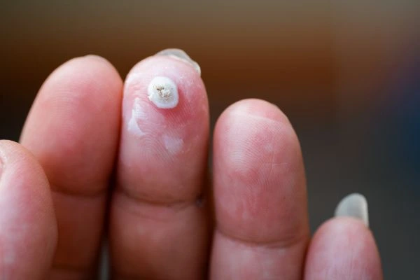wart on person finger - cryotherapy to treat from LA LIPO Woodford
