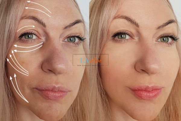 Morpheus 8 results Woodford face lift.