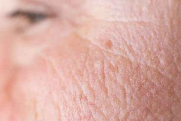 close up picture of a woman's face showing an age spot Woodford