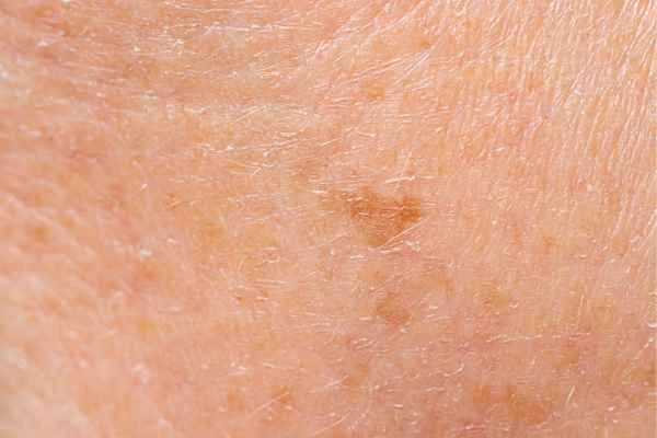 close up picture of age spots Woodford