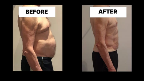 What Symptoms Can Diastasis Recti Cause in Men? Weak Core, Back Pain and Poor Posture Woodford